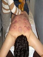 Massage oder schroepfen